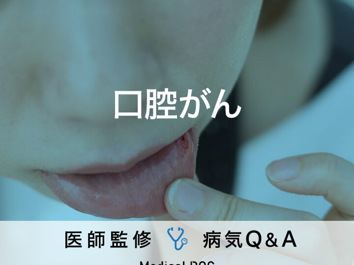 口の中の血豆とがんの関係性・画像で確認する方法