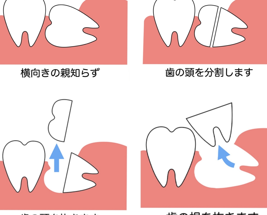 親知らず抜歯後の腫れは何日続くか詳しく解説